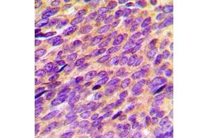Immunohistochemical analysis of ORAOV1 staining in human breast cancer formalin fixed paraffin embedded tissue section.