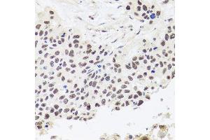 Immunohistochemistry of paraffin-embedded human lung cancer using RPP30 antibody. (RPP30 anticorps  (AA 1-268))