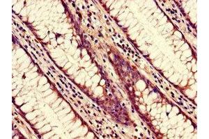 Immunohistochemistry of paraffin-embedded human colon cancer using ABIN7161824 at dilution of 1:100
