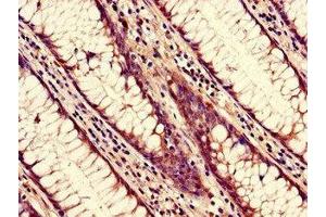 Immunohistochemistry of paraffin-embedded human colon cancer using ABIN7161824 at dilution of 1:100 (NUP85 anticorps  (AA 201-500))