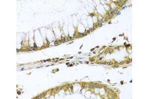 Immunohistochemistry of paraffin-embedded Human colon carcinoma using PMPCB Polyclonal Antibody at dilution of 1:100 (40x lens). (PMPCB anticorps)