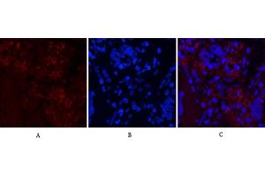 Immunofluorescence analysis of human lung cancer tissue. (Notch1 anticorps  (Cleaved-Val1754))