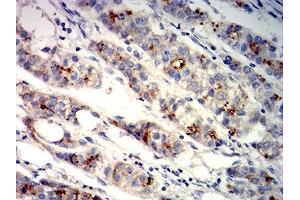 Immunohistochemical analysis of paraffin-embedded liver cancer tissues using GPC3 mouse mAb with DAB staining. (Glypican 3 anticorps  (AA 359-554))