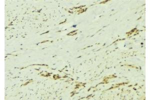 ABIN6276892 at 1/100 staining Human breast cancer tissue by IHC-P.