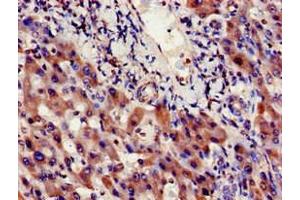 Immunohistochemistry of paraffin-embedded human liver cancer using ABIN7156348 at dilution of 1:100 (INSIG1 anticorps  (AA 1-87))