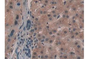 Detection of GaA in Human Liver cancer Tissue using Polyclonal Antibody to Glucosidase Alpha, Acid (GaA) (GAA anticorps  (AA 595-770))