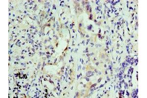 Immunohistochemistry of paraffin-embedded human lung cancer using ABIN7156126 at dilution of 1:100 (KPNA1 anticorps  (AA 8-538))