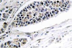 Immunohistochemistry (IHC) analyzes of KDEL Receptor 2 antibody in paraffin-embedded human lung carcinoma tissue. (KDELR2 anticorps)