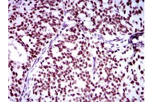 Immunohistochemical analysis of paraffin-embedded cervical cancer tissues using Ring1 mouse mAb with DAB staining.