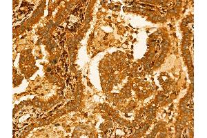 ABIN7094259 and ABIN7098306 at 1/100 staining Human lung cancer by IHC-P. (GLTP anticorps  (Internal Region))