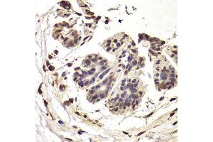 Immunohistochemistry of paraffin-embedded human breast cancer using INTS6 Antibody. (INTS6 anticorps  (AA 1-280))