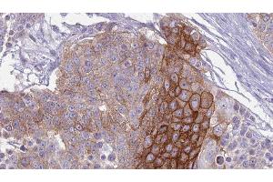 ABIN6279169 at 1/100 staining Human urothelial cancer tissue by IHC-P. (ABCC9 anticorps  (C-Term))