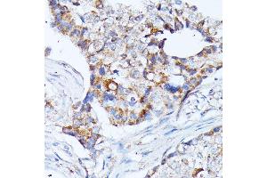Immunohistochemistry of paraffin-embedded human breast cancer using KCNJ15 antibody (ABIN7269475) at dilution of 1:100 (40x lens).