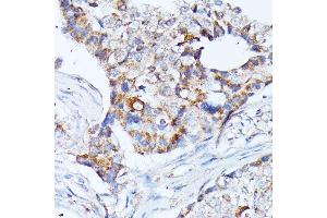 Immunohistochemistry of paraffin-embedded human breast cancer using KCNJ15 antibody (ABIN7269475) at dilution of 1:100 (40x lens). (KCNJ15 anticorps  (AA 221-375))
