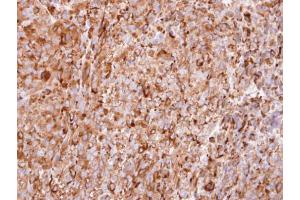 IHC-P Image Immunohistochemical analysis of paraffin-embedded CL1-5 xenograft, using interferon alpha 2, antibody at 1:100 dilution.