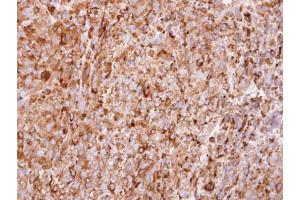 IHC-P Image Immunohistochemical analysis of paraffin-embedded CL1-5 xenograft, using interferon alpha 2, antibody at 1:100 dilution.