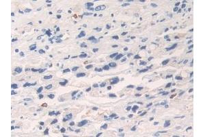 Detection of KLK6 in Human Prostate cancer Tissue using Polyclonal Antibody to Kallikrein 6 (KLK6)
