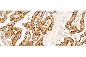 Immunohistochemistry of paraffin-embedded Human thyroid cancer tissue using NUP210 Polyclonal Antibody at dilution of 1:30(x200)