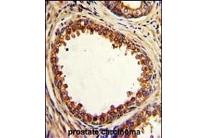 Formalin-fixed and paraffin-embedded human prostate carcinoma with PTP4A2 Antibody (Center), which was peroxidase-conjugated to the secondary antibody, followed by DAB staining.