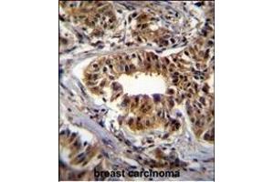 CAD Antibody (Center) (ABIN655062 and ABIN2844692) immunohistochemistry analysis in formalin fixed and paraffin embedded human breast carcinoma followed by peroxidase conjugation of the secondary antibody and DAB staining.