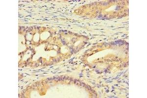 Immunohistochemistry of paraffin-embedded human colon cancer using ABIN7174792 at dilution of 1:100 (C1ORF53 anticorps  (AA 1-145))