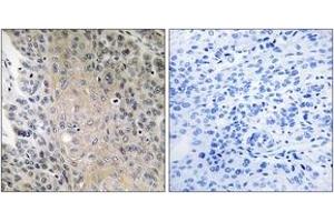 Immunohistochemistry analysis of paraffin-embedded human lung carcinoma, using RAB41 Antibody. (RAB41 anticorps  (AA 115-164))