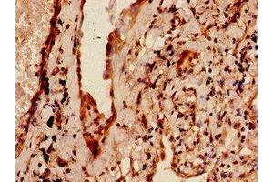 Immunohistochemistry of paraffin-embedded human lung cancer using ABIN7159758 at dilution of 1:100 (MAP4 anticorps  (AA 575-818))