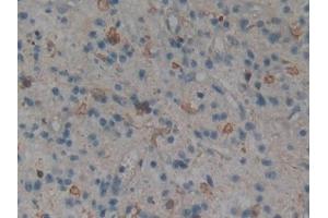 Detection of MAPK11 in Human Glioma Tissue using Polyclonal Antibody to Mitogen Activated Protein Kinase 11 (MAPK11) (MAPK11 anticorps  (AA 38-277))