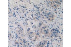 Detection of EBI3 in Human Breast Cancer Tissue using Monoclonal Antibody to Epstein Barr Virus Induced Protein 3 (EBI3)