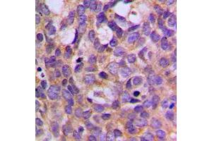 Immunohistochemical analysis of S6K1 (pT444) staining in human breast cancer formalin fixed paraffin embedded tissue section. (RPS6KB1 anticorps  (C-Term, pSer444))