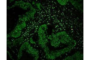 IF analysis of CTBP1 using anti-CTBP1 antibody (ABIN3043816) CTBP1 was detected in paraffin-embedded section of human intestinal cancer tissues. (CTBP1 anticorps  (C-Term))