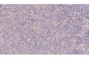 ABIN6273077 at 1/100 staining Human lymph cancer tissue by IHC-P. (SRP9 anticorps  (Internal Region))