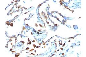 FFPE human lung carcinoma tested with MFGE8 antibody (MFG-06) (MFGE8 anticorps)