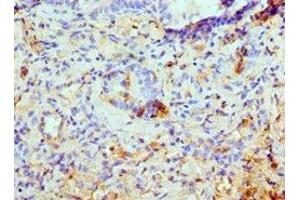 Immunohistochemistry of paraffin-embedded human lung cancer using ABIN7145103 at dilution of 1:100