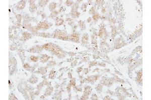 IHC-P Image Immunohistochemical analysis of paraffin-embedded human breast cancer, using FSTL1, antibody at 1:250 dilution.