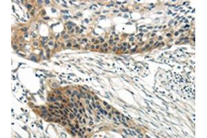 The image on the left is immunohistochemistry of paraffin-embedded Human esophagus cancer tissue using ABIN7193067(WNT6 Antibody) at dilution 1/35, on the right is treated with synthetic peptide. (WNT6 anticorps)