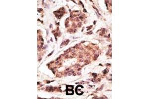 Formalin-fixed and paraffin-embedded human cancer tissue reacted with the primary antibody, which was peroxidase-conjugated to the secondary antibody, followed by DAB staining.