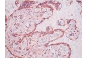 Immunohistochemistry (IHC) image for anti-Matrix Metallopeptidase 11 (Stromelysin 3) (MMP11) antibody (ABIN781659)