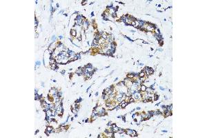 Immunohistochemistry of paraffin-embedded human breast cancer using ATG7 antibody (ABIN6292614) at dilution of 1:100 (40x lens). (ATG7 anticorps)