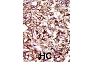 Formalin-fixed and paraffin-embedded human hepatocellular carcinoma tissue reacted with CDK2 polyclonal antibody  , which was peroxidase-conjugated to the secondary antibody, followed by DAB staining. (CDK2 anticorps  (C-Term))