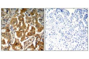 Immunohistochemical analysis of paraffin-embedded human lung carcinoma tissue using ADD1(Phospho-Ser726) Antibody(left) or the same antibody preincubated with blocking peptide(right).