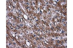 Immunohistochemical staining of paraffin-embedded Carcinoma of liver tissue using anti-PASKmouse monoclonal antibody. (PASK anticorps)