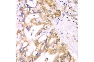 Immunohistochemistry of paraffin-embedded human liver cancer using ACADS antibody. (ACADS anticorps  (AA 1-260))