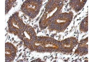 IHC-P Image Immunohistochemical analysis of paraffin-embedded human colon carcinoma, using QDPR, antibody at 1:500 dilution. (QDPR anticorps)