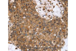 Immunohistochemistry of Human lung cancer using TPM2 Polyclonal Antibody at dilution of 1:35 (TPM2 anticorps)