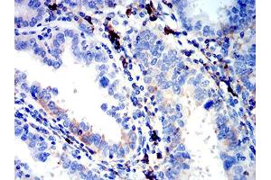 Immunohistochemical analysis of paraffin-embedded endometrial cancer tissues using IGLC2 mouse mAb with DAB staining. (IGLC2 anticorps  (AA 1-106))