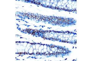 Immunohistochemistry of paraffin-embedded human colon using  Rabbit mAb (ABIN7265458) at dilution of 1:100 (40x lens). (ADAR anticorps)