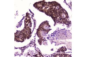 IHC testing of FFPE human colon cancer with p65 antibody at 2ug/ml.