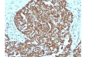 Formalin-fixed, paraffin-embedded human ovarian carcinoma stained with Nucleolin antibody. (Nucleolin anticorps)