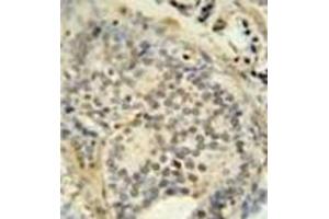 Immunohistochemistry analysis in formalin fixed and paraffin embedded human prostate carcinoma stained with FUS Antibody (C-term) followed by peroxidase conjugation of the secondary antibody and DAB staining.